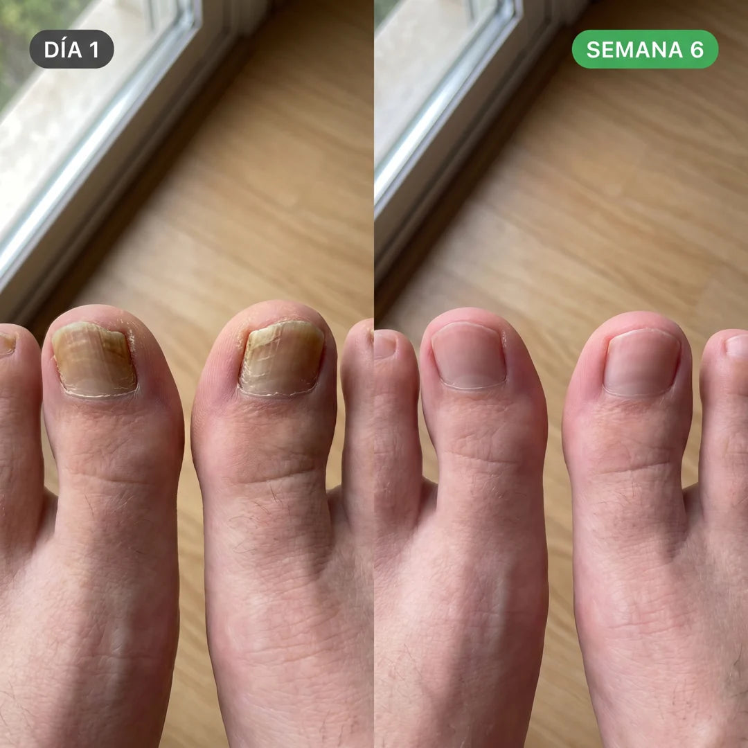 Antes despues uñas pies semana 6